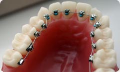 Aparat Dentar Lingual STB